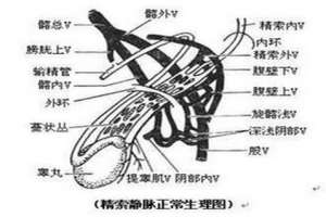 静脉曲张的治疗方法